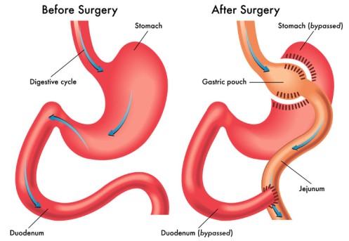 Laparoscopic Gastric Bypass Surgery by OrangeCountySurgeons